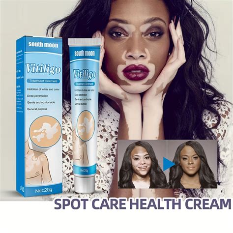 Vitiligo Treatment Cream Vitiligo Cream Treatment Vitiligo Treatment ...