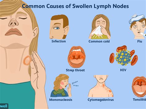 Swollen lymph nodes in neck one side - palfiln