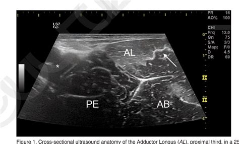 Figure 1 from Perivascular Adductor Longus muscle injury: Ultrasound ...