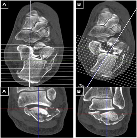 Pathoanatomy of the Tongue-Type Calcaneus Fracture: Assessme ...