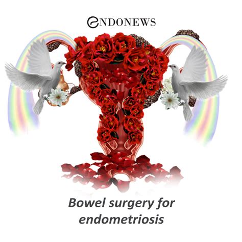 Bowel surgery for endometriosis | EndoNews