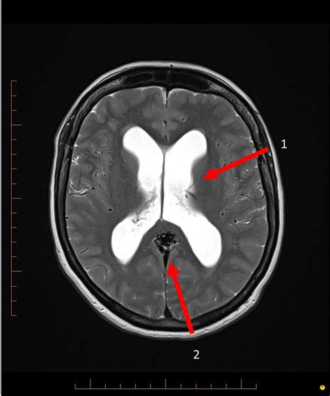 Cureus | Obstructive Hydrocephalus Due to Unruptured Brain Arteriovenous Malformation ...