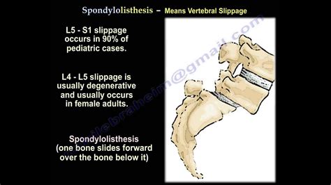 Spondylolysis,Spondylolisthesis,Spondylitis&Spondylosis-EverythingYou Need To Know-Dr.Nabil ...