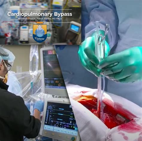 Cardiopulmonary Bypass Video Is an Effective Learning Tool | Ochsner Journal