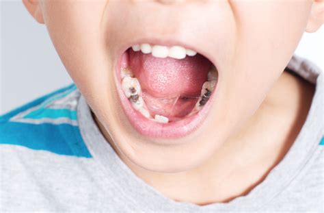 Prevalence of Cavities in Children | Family & Cosmetic Dentistry