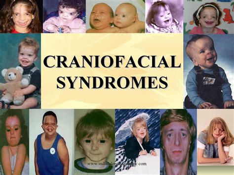 Craniofacial syndromes/ dental implant courses by Indian dental academy by indiandentalacademy ...