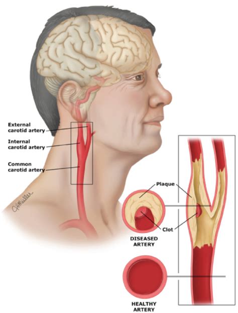 Carotid Artery Disease & Stroke - Victorian Vascular