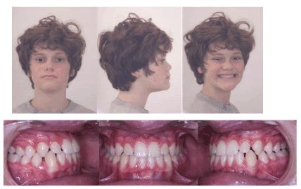 Functional treatment of maxillary hypoplasia and mandibular prognathism