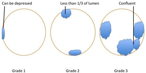 Esophageal Varices Grading