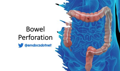 emDOCs.net – Emergency Medicine EducationBowel Perforation: ED presentations, evaluation, and ...