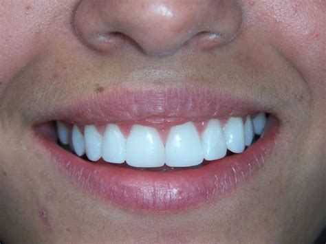 Cosmetic Dental Bonding Near Me | Dental Bonding Houston TX | Cosmetic teeth, Dental cosmetics ...