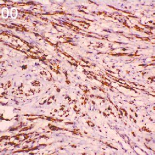 Histology of the neurofibroma with mucinous degeneration (H&E... | Download Scientific Diagram