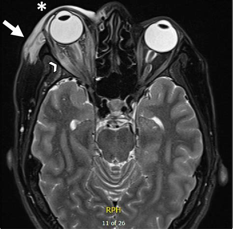 Carotid-Cavernous Fistula in a Patient With Unilateral Periorbital Swelling and Proptosis ...