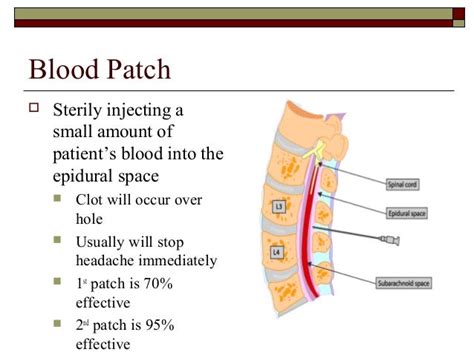 Persistent Headache After Epidural Blood Patch - todayasiaec.over-blog.com