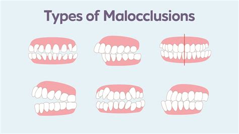 Malocclusion : treatments, types and consequences