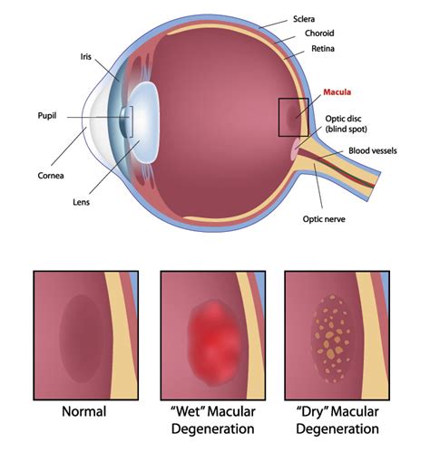 Macular Degeneration Pittsburgh | Eye Examinations Mt. Pleasant, PA