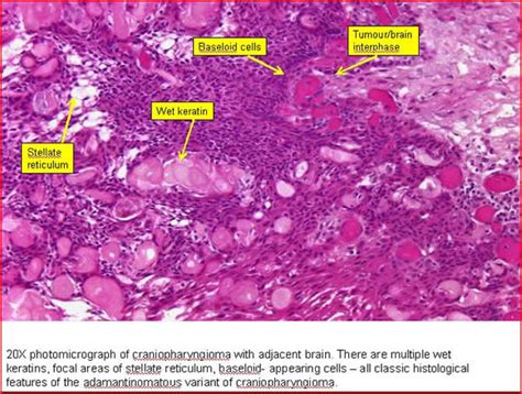 Craniopharyngioma Histology