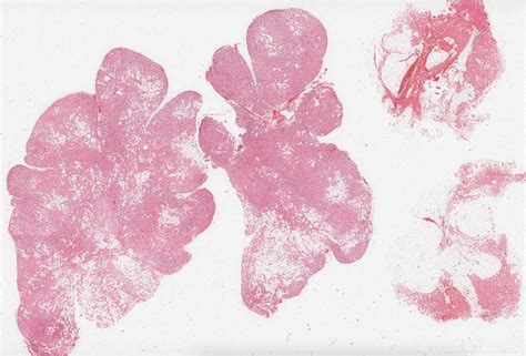 Pathology Outlines - Angiolipoma