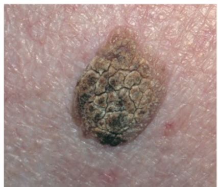 seborrheic keratosis scalp - pictures, photos