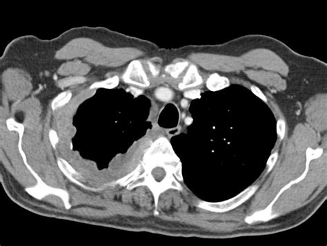 Mesothelioma Right Pleural Space - Chest Case Studies - CTisus CT Scanning