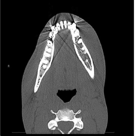 3D sagittal view/ORIF of the mandible fracture and close reduction of... | Download Scientific ...