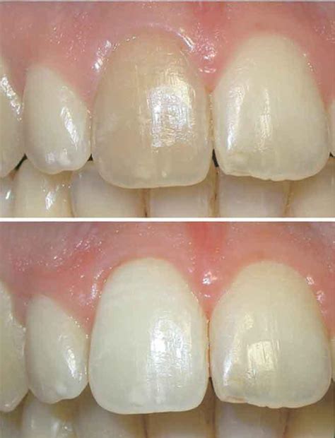 Internal Bleaching: Nicole Mermet, DMD: Dentist