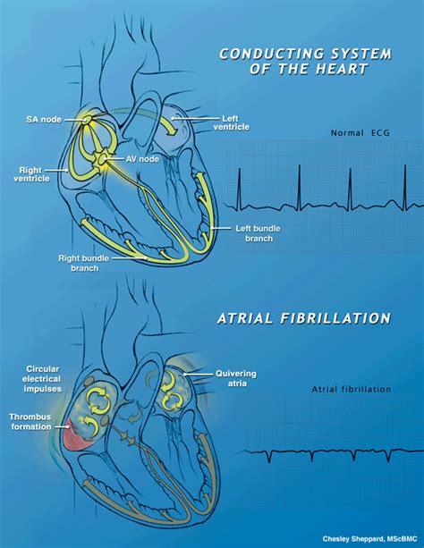 Cardioversion to “Kick-start” a Heart to Normal Sinus Rhythm | HealthPlexus.net