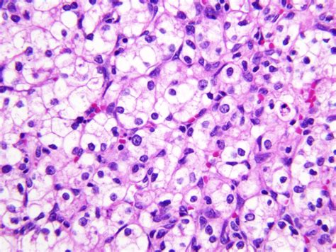 Pathology Outlines - Clear cell