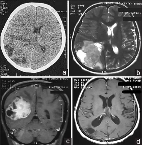 Gliosarcoma with long progression free survival: A case report and ...