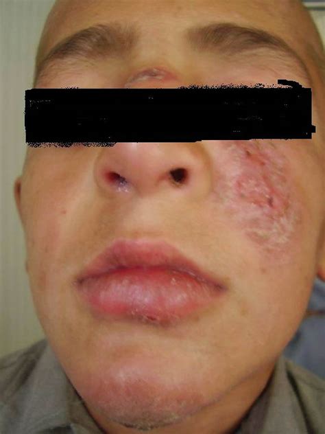 Cutaneous, visceral & mucocutaneous leishmaniasis symptoms & treatment