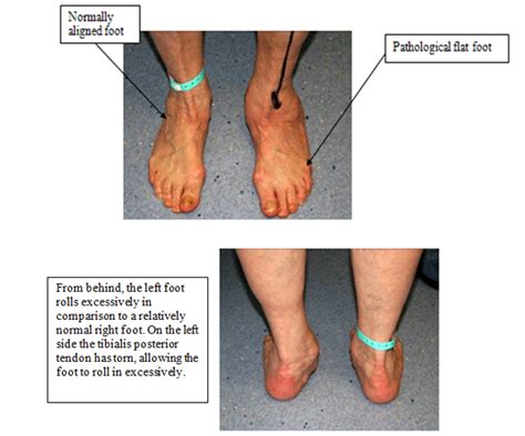 Treating the Flat Foot — Chelsea and Westminster Hospital NHS Foundation Trust