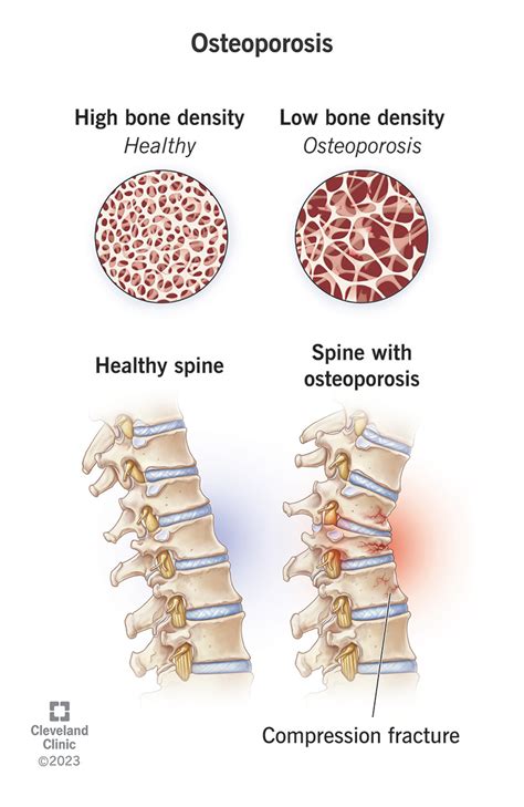 Osteoporosis Care Plan: Specific Nursing Care and Diagnosis