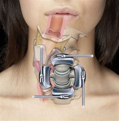 acdf surgery - Google Search | Neck surgery, Spine surgery, Acdf surgery