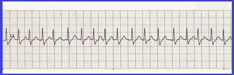 Float Nurse: Practice EKG Rhythm Strips 225