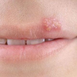 Oral Herpes (Herpes Simplex Labialis, Cold Sores, Fever Blisters ...