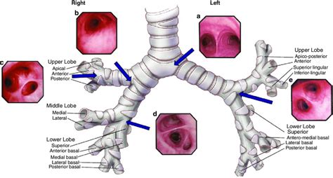 1 Tracheobronchial anatomy and fiberoptic bronchoscopy exam with the... | Download Scientific ...