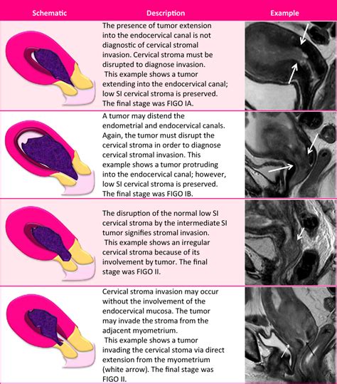 Endometrial Cancer MRI staging: Updated Guidelines of the European ...