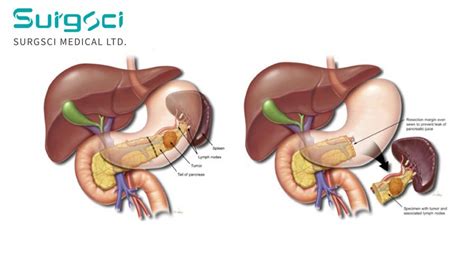 China Surgsci Medical Ltd. latest company news about Distal Pancreatectomy: Procedure ...