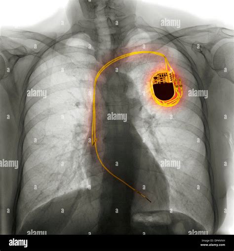 Dual chamber pacemaker, X-ray Stock Photo - Alamy