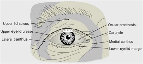 socket_anatomy_1 - New Zealand Prosthetic Eye Service