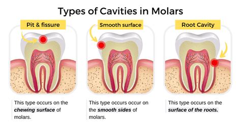 Cavities in Molars: Symptoms, Causes, & Treatment - Share Dental Care