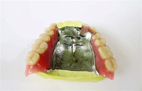 Partial Plates for a Perfect Smile | Comfortable Dental Prosthetics