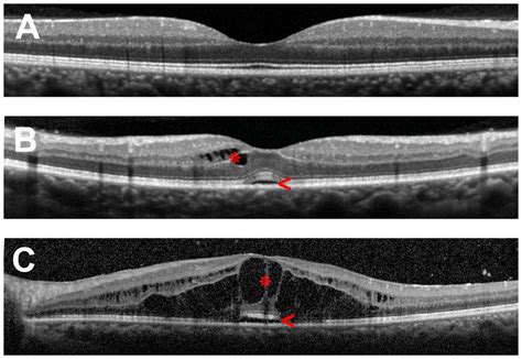 Frontiers | Mechanisms of macular edema