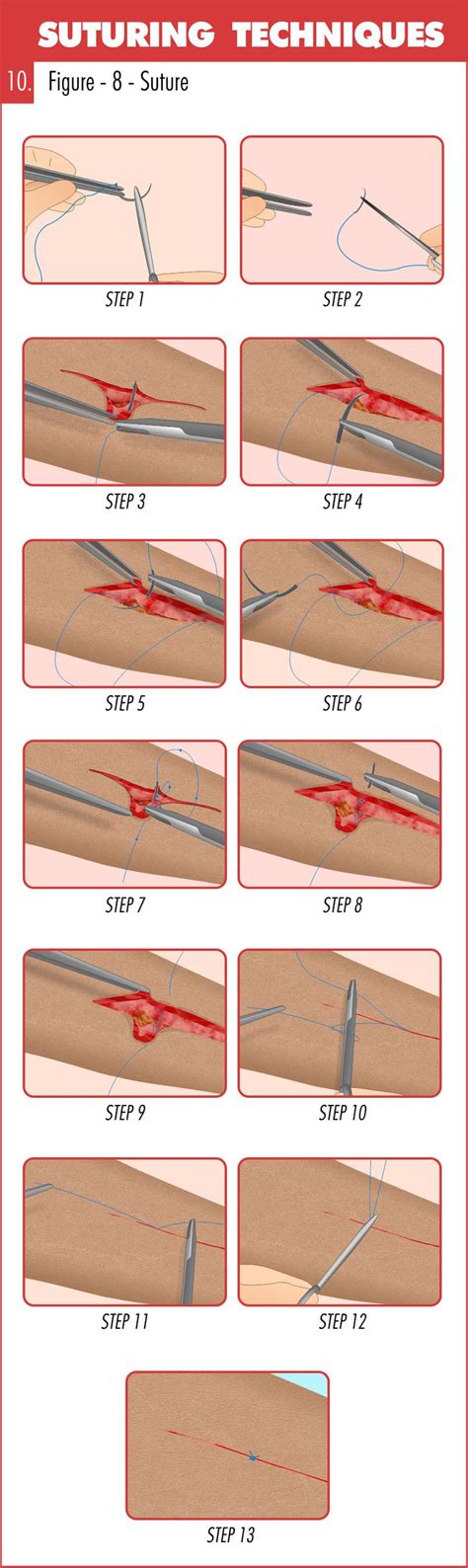 Surgical Suturing Techniques Mastery Guide - Apprentice Doctor