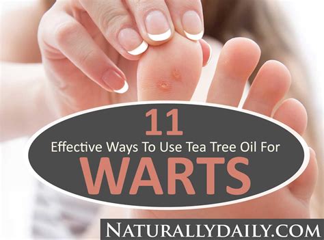 Tea Tree Oil for Warts: 11 Effective Ways to Use