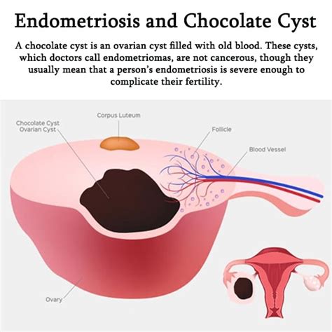 Endometriosis and Chocolate Cyst | Diagnosis, Causes, Symptoms, Treatment