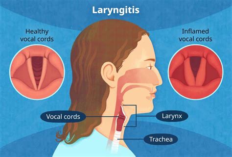 Understanding Laryngitis: Causes, Symptoms, And Treatment - Ask The ...