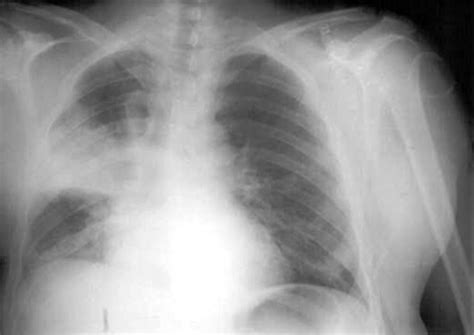 Right upper lobe consolidation: an unusual complication of an uneventful endotracheal intubation ...