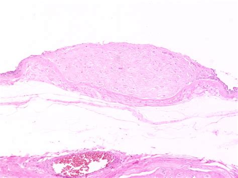 amnion nodosum placenta histology