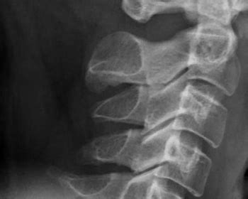 What is cervical calcification? - Symptoms, Causes, Treatment